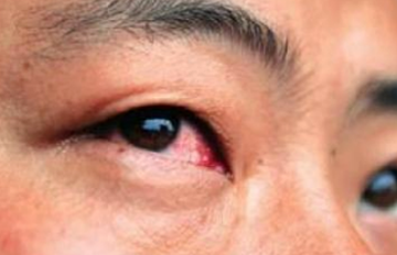 原创你的眼睛藏有肝脏病变信号简单3招教你养肝又明目