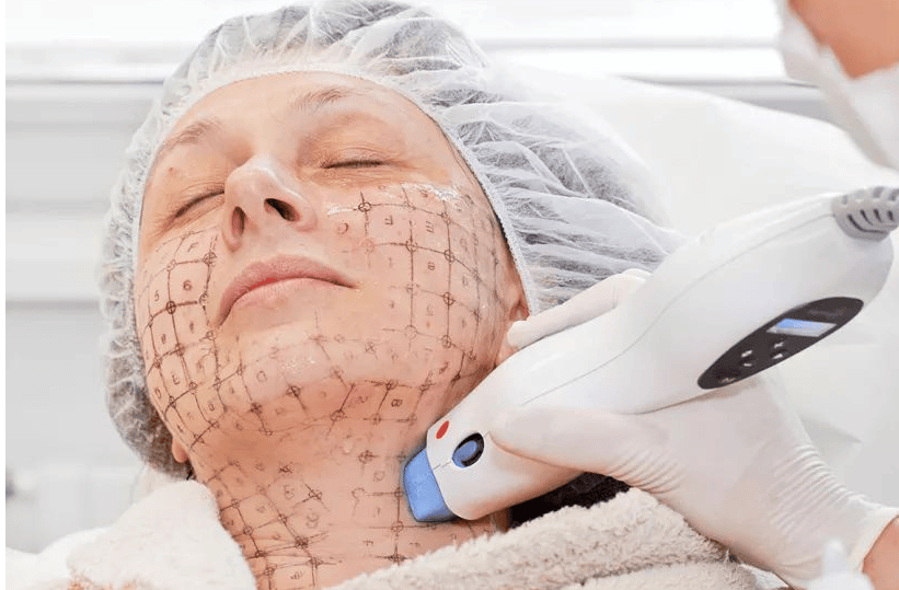 (热玛吉,射频和热玛吉的区别)热玛吉美容误区大家要知道1,热玛吉美容