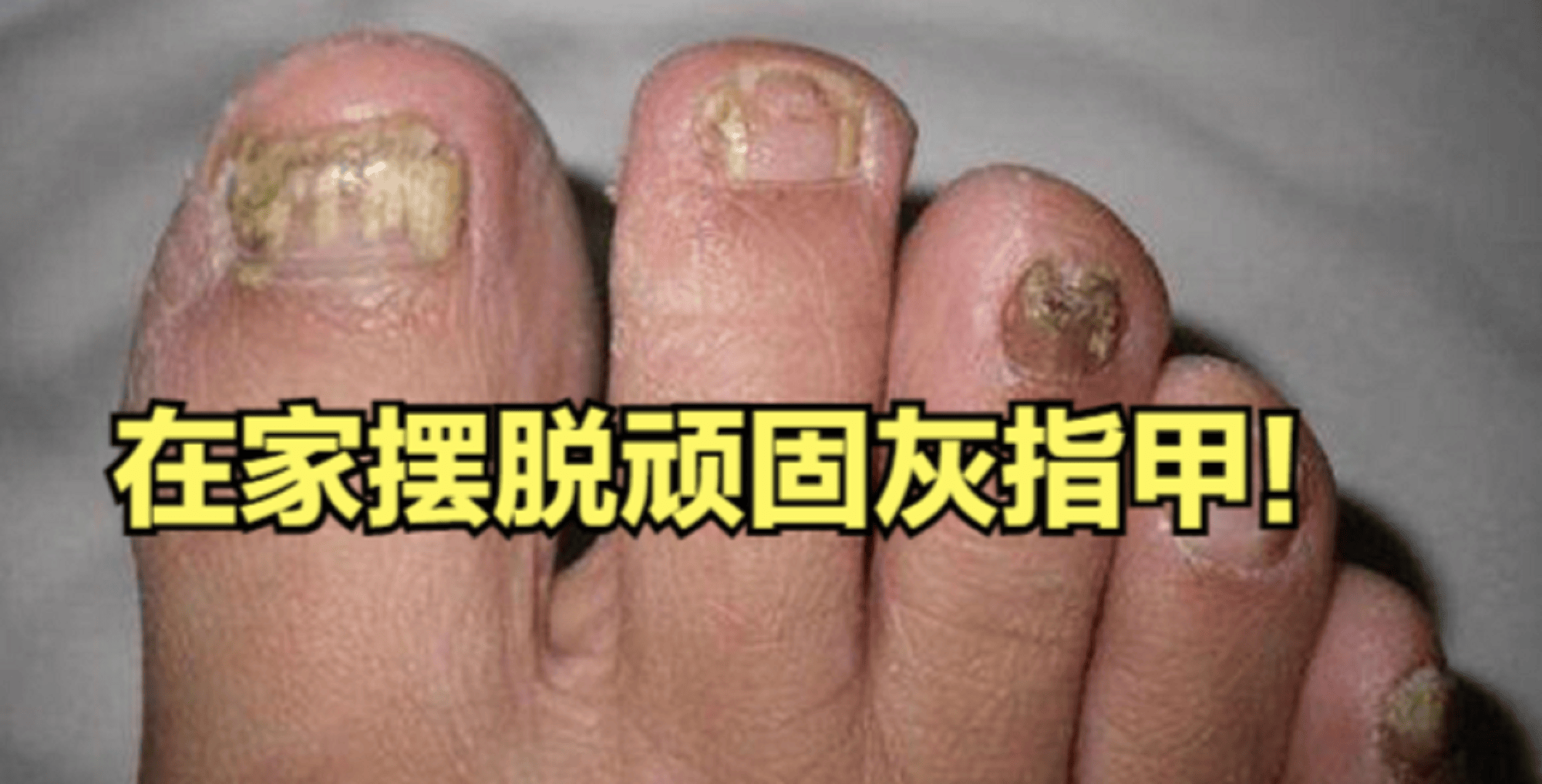 3款国货抑菌液测评任用一款顽固灰指甲在家根治不反复