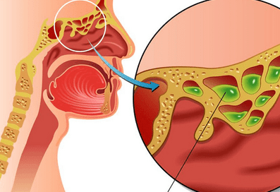 鼻窦炎白色分泌物图片图片