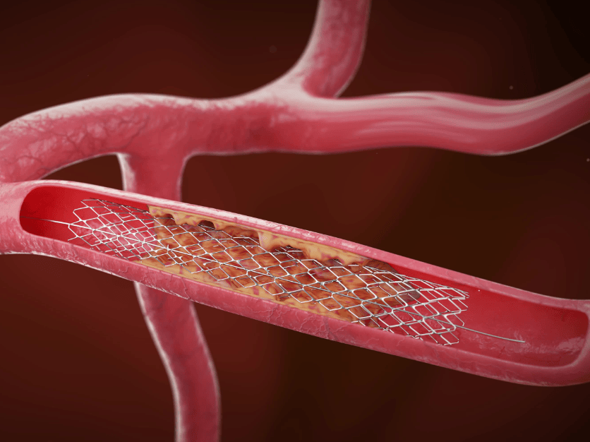 国内将逐渐停止"心脏支架"的手术?做完人就废了?告诉你真相