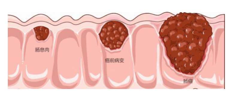 这种息肉十有八九会癌变