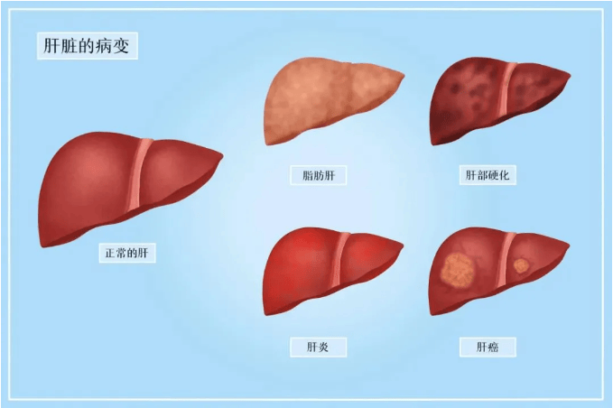 最新体检数据发现:近七成体重正常者患脂肪肝,脂肪肝可以逆转吗?