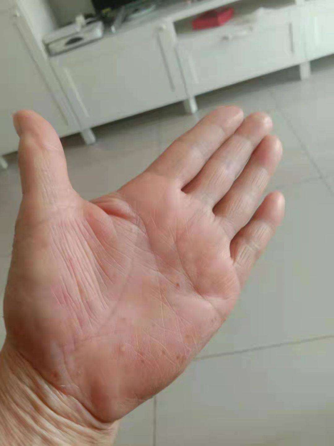 问止中医 | 丘述兴医师:打疫苗后出现汗疱疹_治疗_患者_皮肤