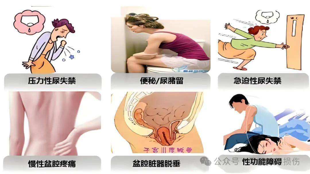 患者可能会感到排尿不畅,尿潴留,甚至出现二便失禁的情况.