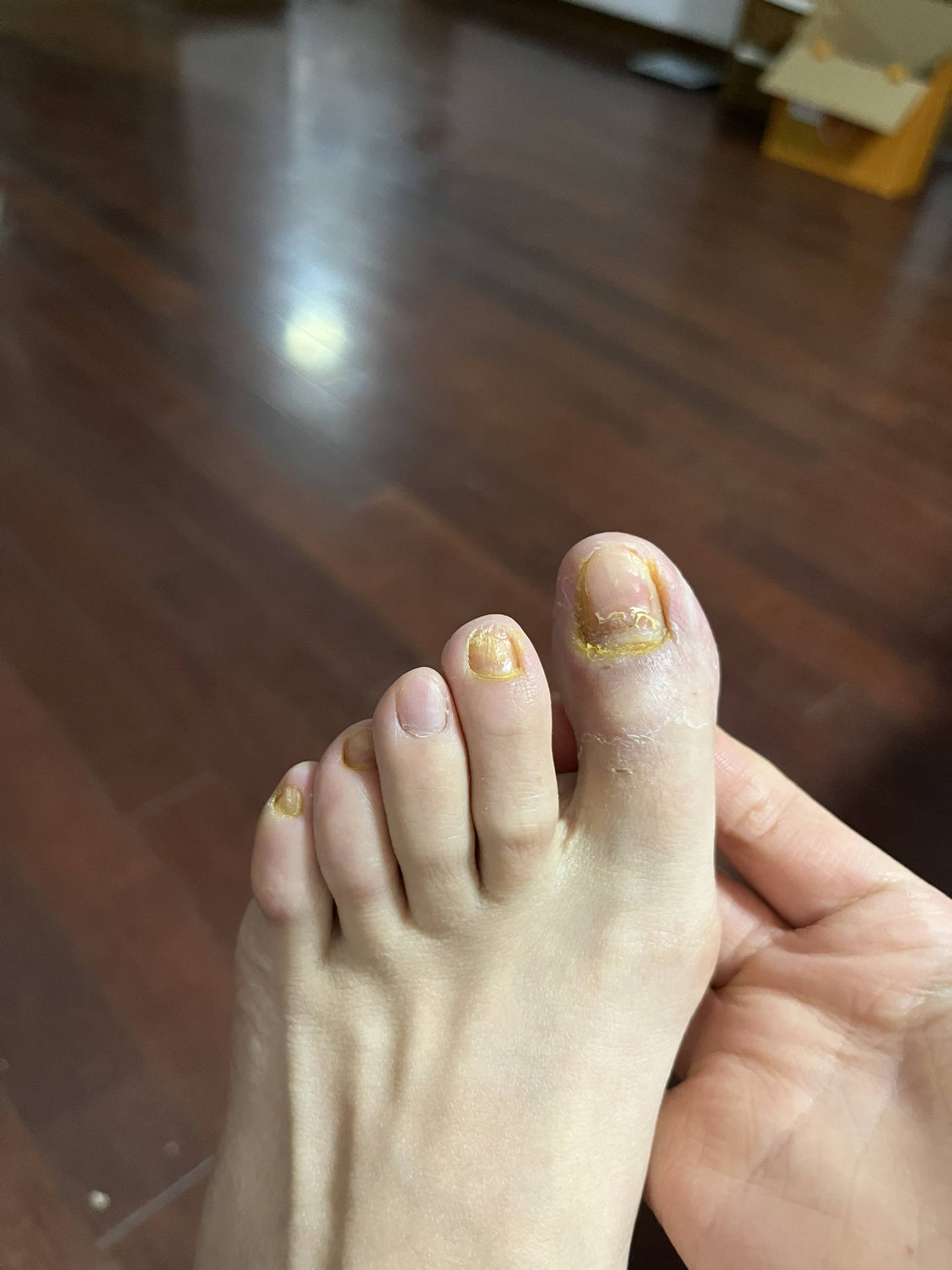 过来人教你不花冤枉钱在家就能根治灰指甲抓紧收藏看