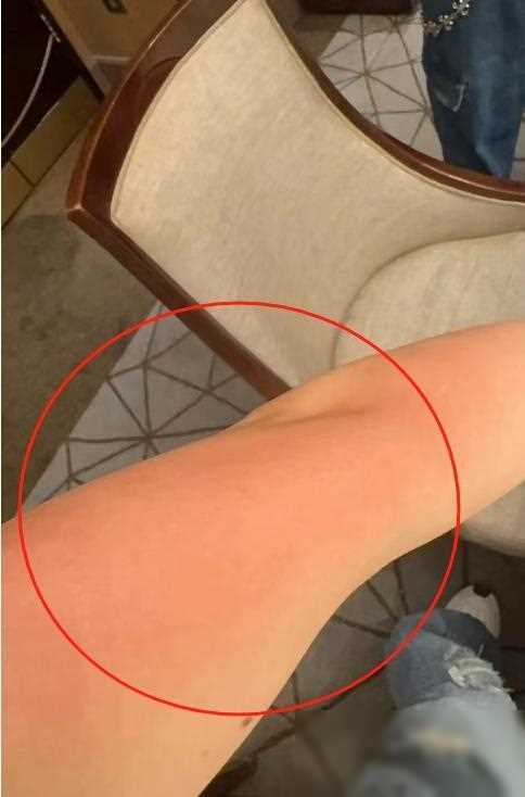 原创杜淳妻子烫伤事件引发热议多处伤口起泡火辣辣疼