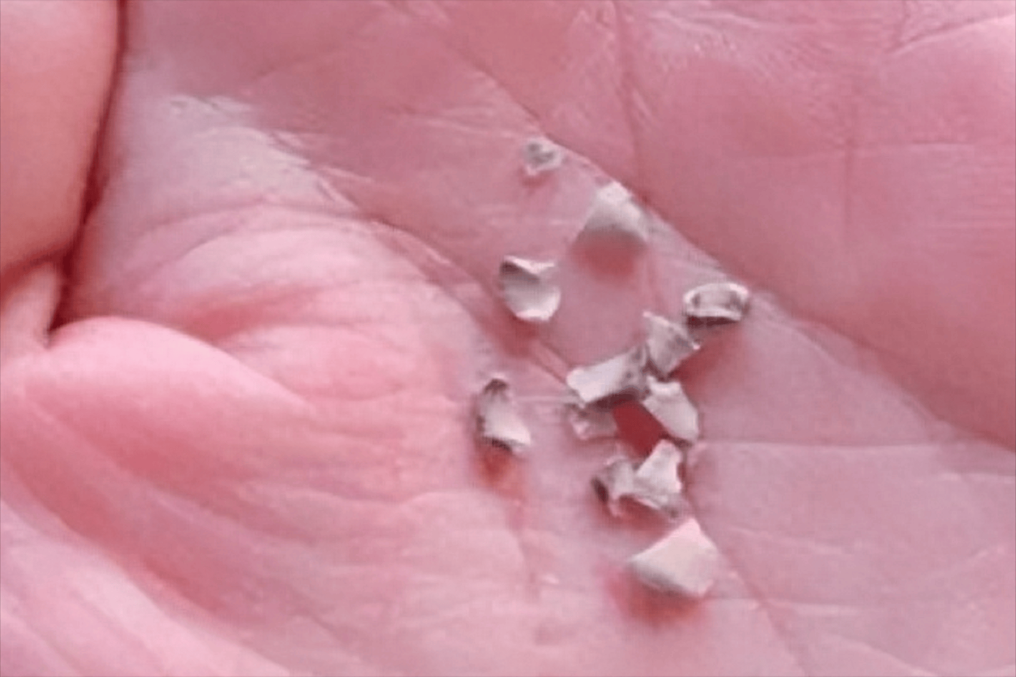 45天在家解决牙结石方法曝光!过来人5年经验不得不服,看完不亏