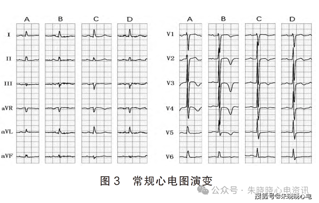 肺栓塞的心电图表现图片