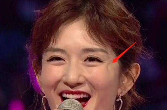 原创谢娜的脸怎么了笑起来眼角出现奇怪凹痕引人质疑是整容后遗症