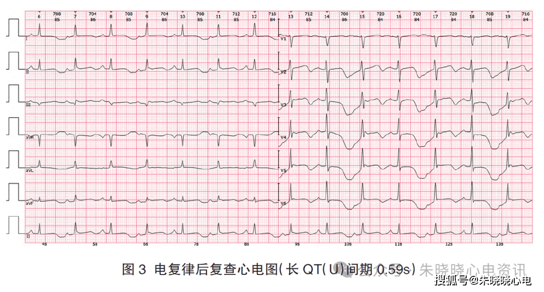 电交替的心电图表现图片