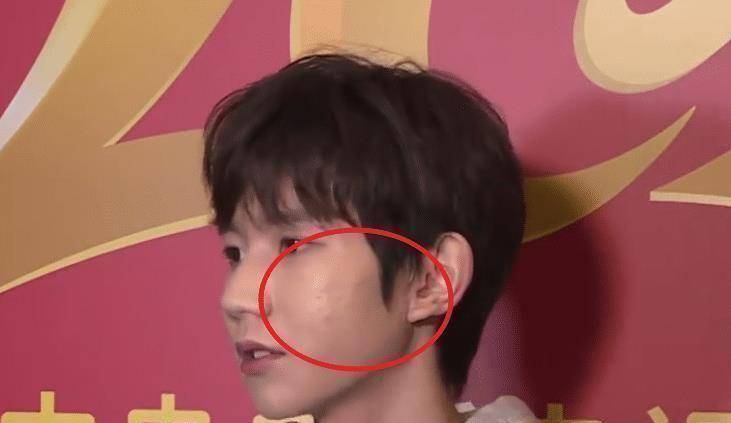 原创王源再次接受电视采访在照妖镜之下面部上痘痘很明显