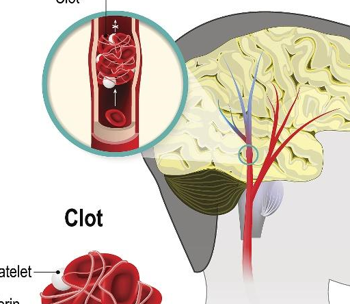 原创脑梗塞早期有什么症状做好这3件事不怕脑梗找上门