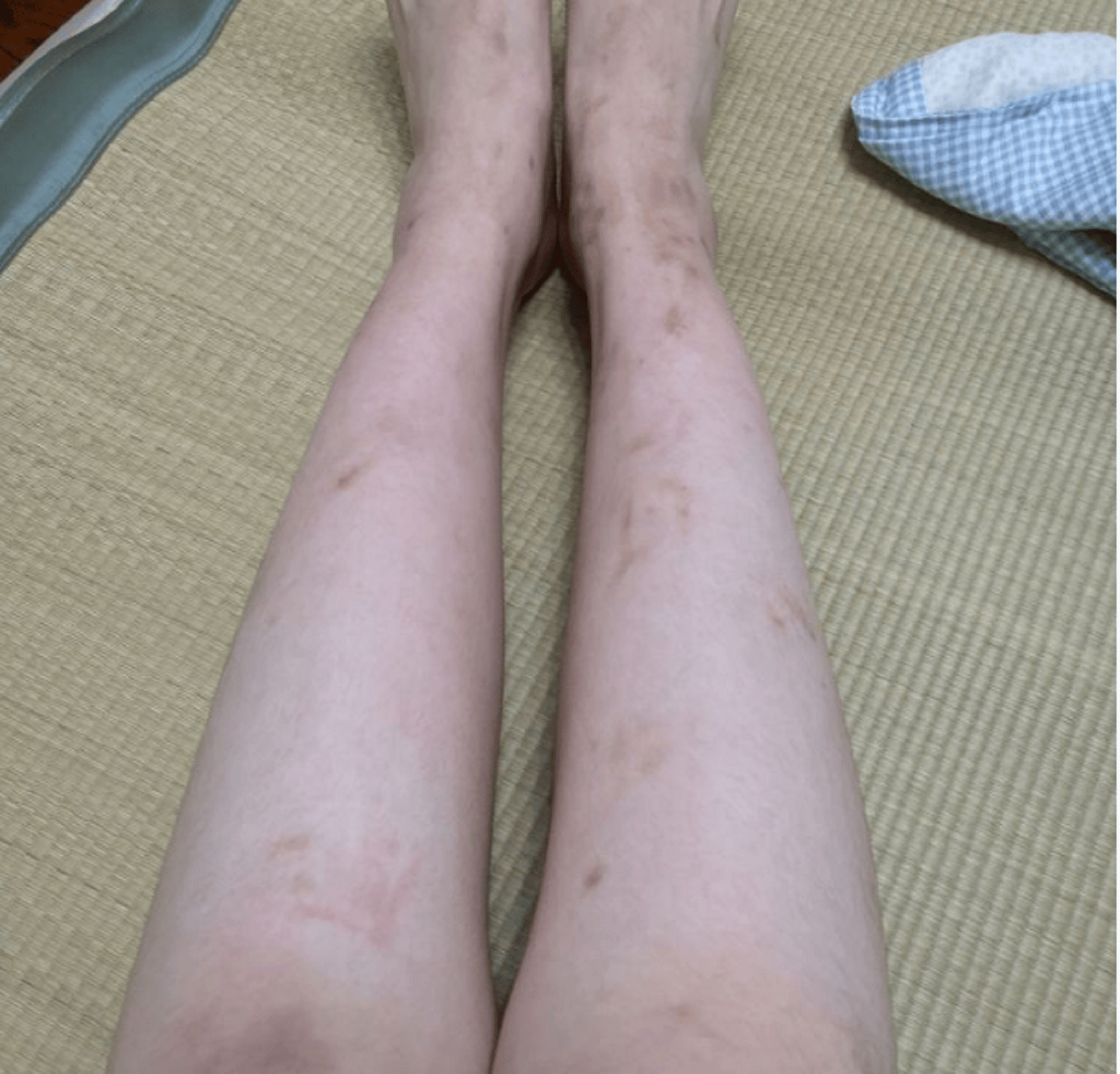 日常清洁做好是成功祛疤的第一步,首先因为我们疤痕体质身上疤痕较多