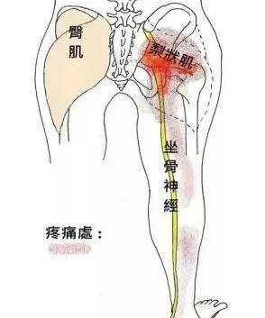 梨状肌体表图片