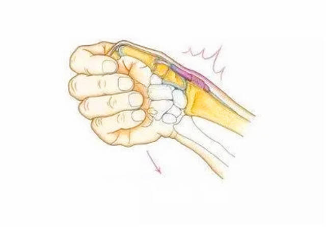 手指屈肌腱鞘炎自愈图片