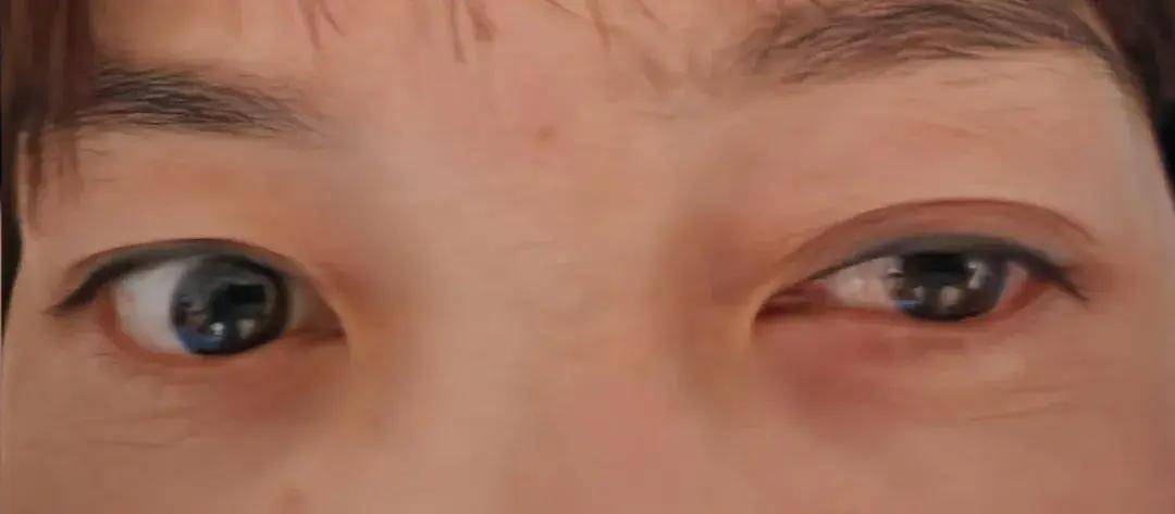 带你了解"超声引导下星状神经节阻滞"