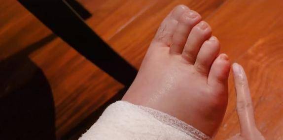 原创陈赫受伤后右脚浮肿为了洗个澡张子萱蹲地为其换药绑上保鲜膜