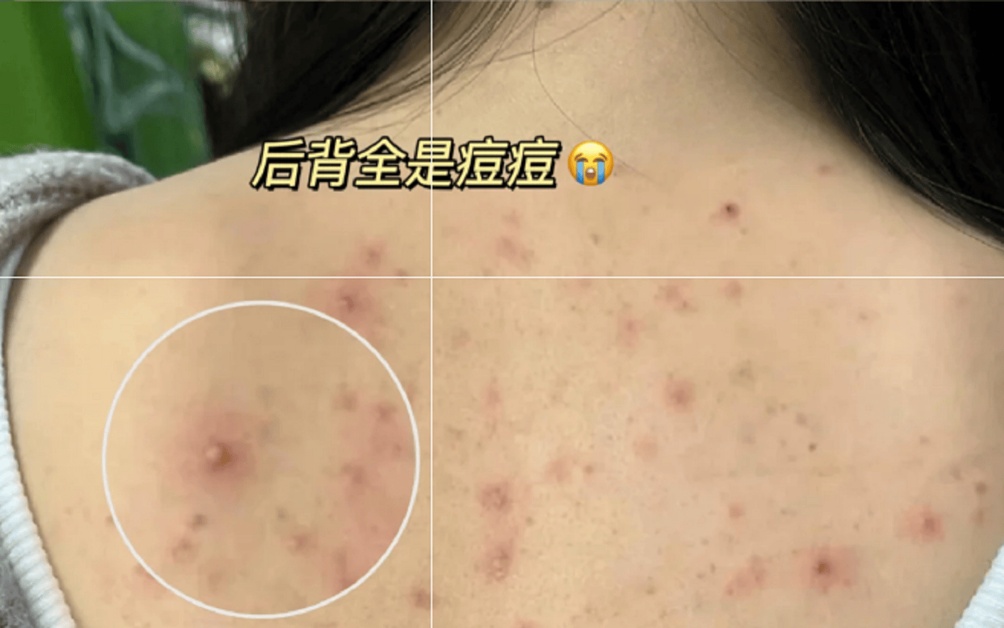 三个方法拯救多年后背痘简单方便易操作建议收藏