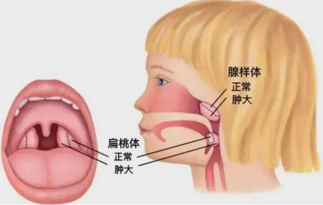 扁桃体假膜图片