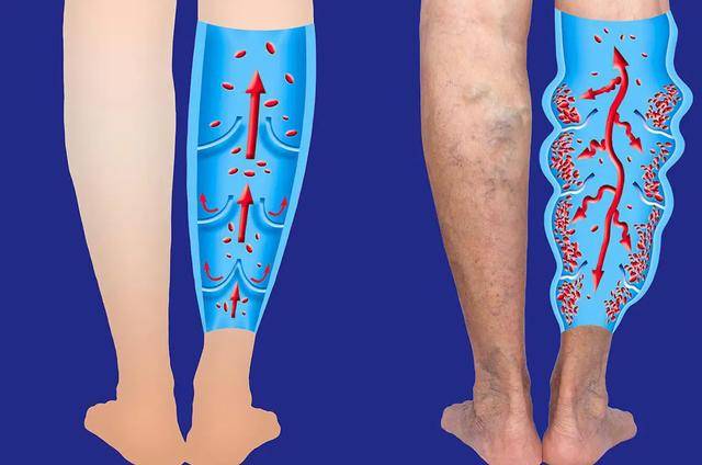 原创腿肿了一圈一按一个坑或许是4种疾病前兆建议尽早就医