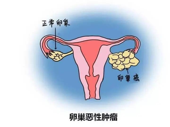 根据我国统计数据显示,50岁以上的女性中卵巢肿瘤的发病率为0.