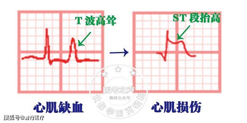 正常心电图波形经常性地饮酒或大量饮酒后,从心肌开始缺血逐渐到心肌
