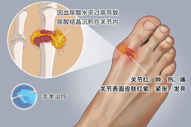 痛风患者不能吃的4种蔬菜是什么(什么人群易得痛风)