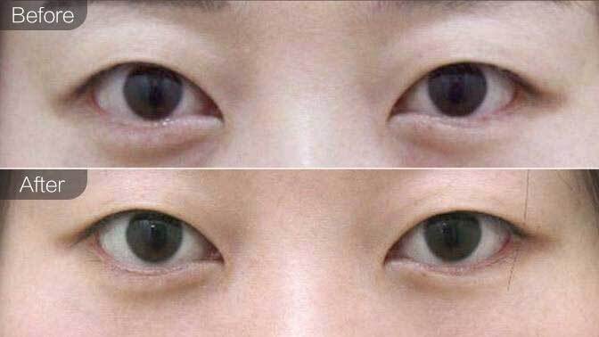 实话~外切眼袋一般要多久才能完全恢复,眼袋切除手术能保几年_皮肤