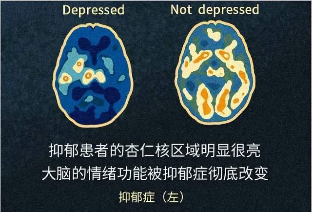 抑郁症百忧解图片图片