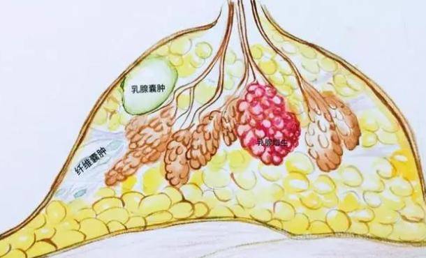 医生提醒:大多数囊肿无需处理,但囊肿若出现在4个地方,须警惕