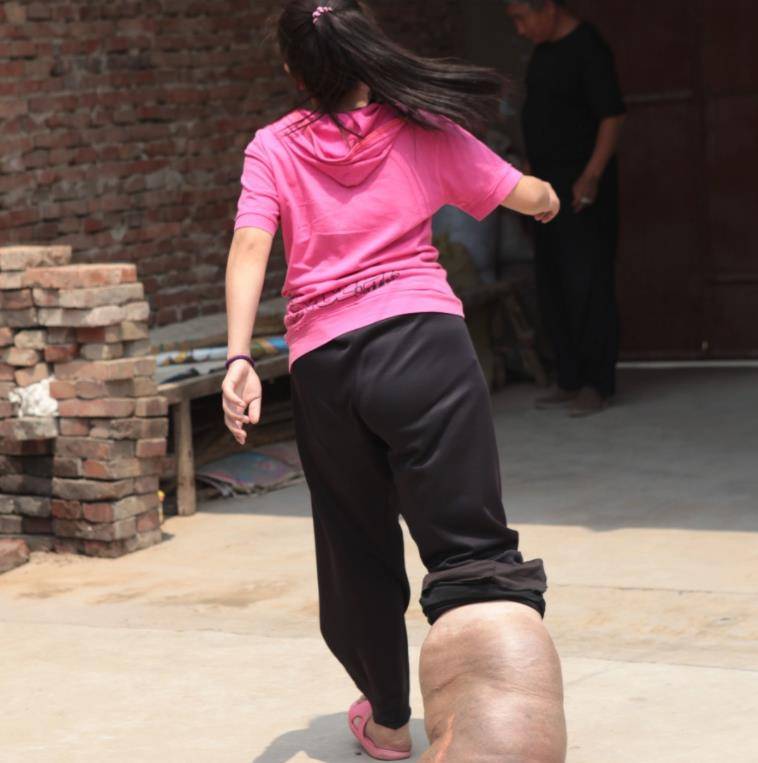 河南巨腿女孩:拖34斤瘤子生活多年,22岁将其锯下,结婚生子