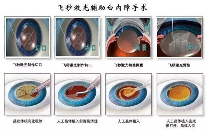 太学眼科开展第四届致敬白衣战士公益活动,老花白内障手术助患者重获