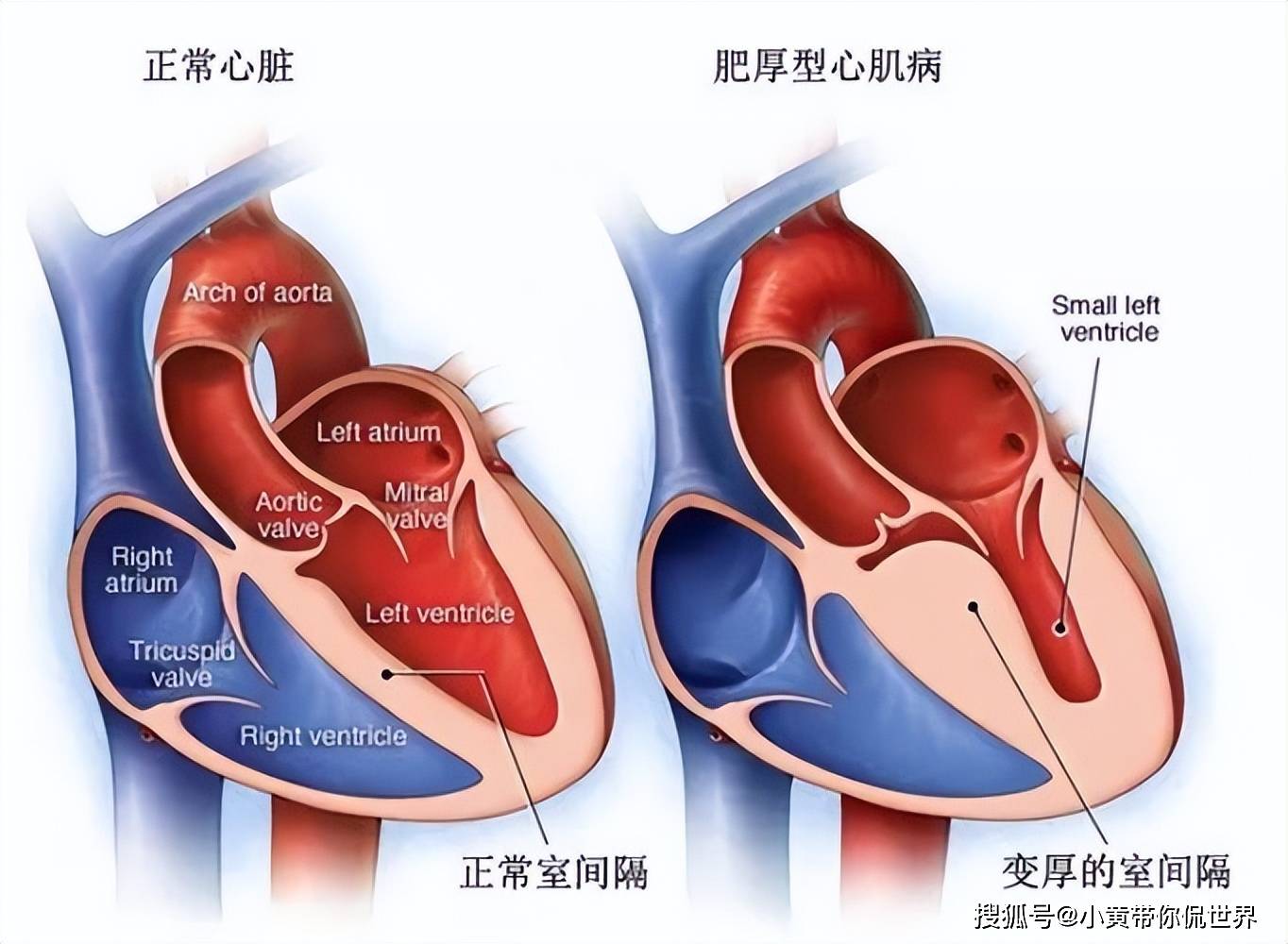 肥厚型心肌病在中国有救了!全球首创新药在中国获批