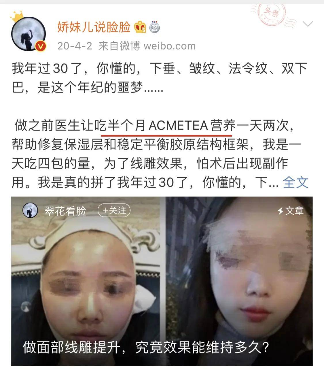 什么原因呢线雕提升后脸部有凹陷咋回事,做完线雕脸部凹凸正常吗
