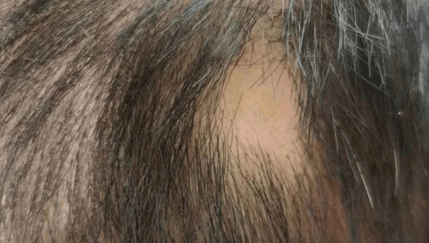 斑秃是什么原因图片