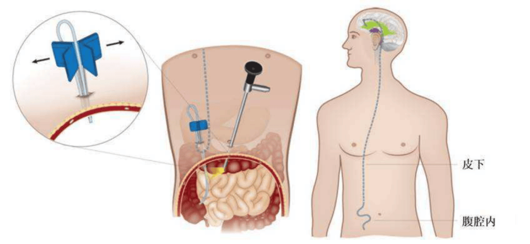 脑积水法宝--脑室腹腔分流术_分流管_症状_患者