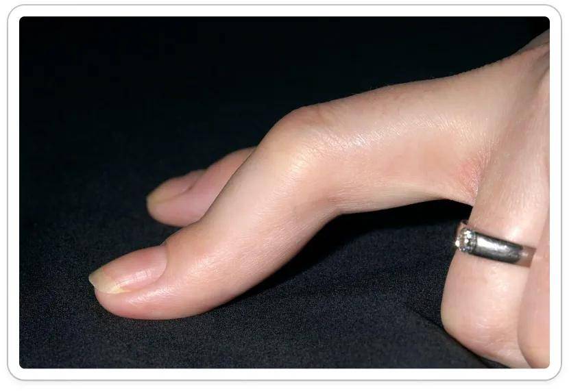 ra早知道,识别类风湿关节炎的早期信号