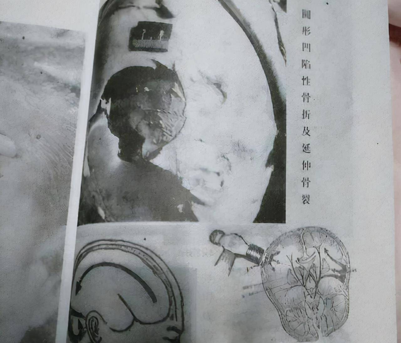 在学习法学相关知识的期间,她也不放弃申诉,法医两次对丈夫尸体进行