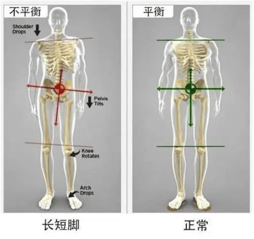 医生可能会通过x光片,ct或mri等影像学检查,确认是否存在长短腿以及它