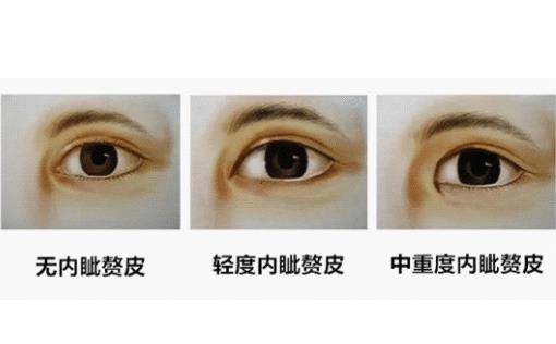 我们就可以看出这一点,表现为上眼睑微微下伸,遮掩泪阜而呈一小小皮褶