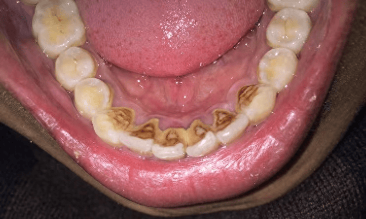 顽固的牙结石不攻自破!只因用对3个方法!60天实现唇红齿白!