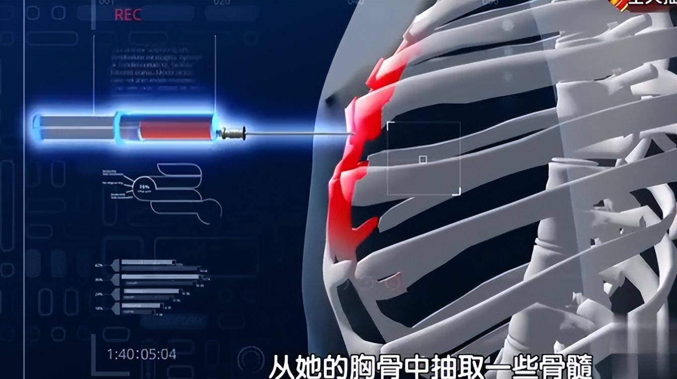 在出租屋休息一天后,玹玹接下来要做的是骨穿,医生需要用穿刺针从她的