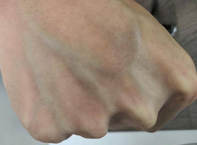 有人手臂"青筋凸起",有的人几乎看不到青筋,谁的更健康呢?