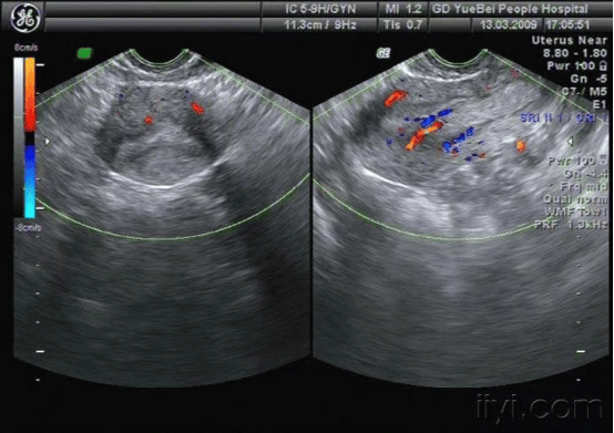 正常子宫彩超图图解图片