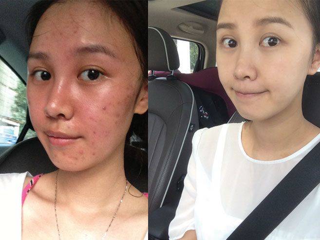 榜二:羽素大灯泡祛痘精华液这款精华液的包装就很有科技感,一看就让人