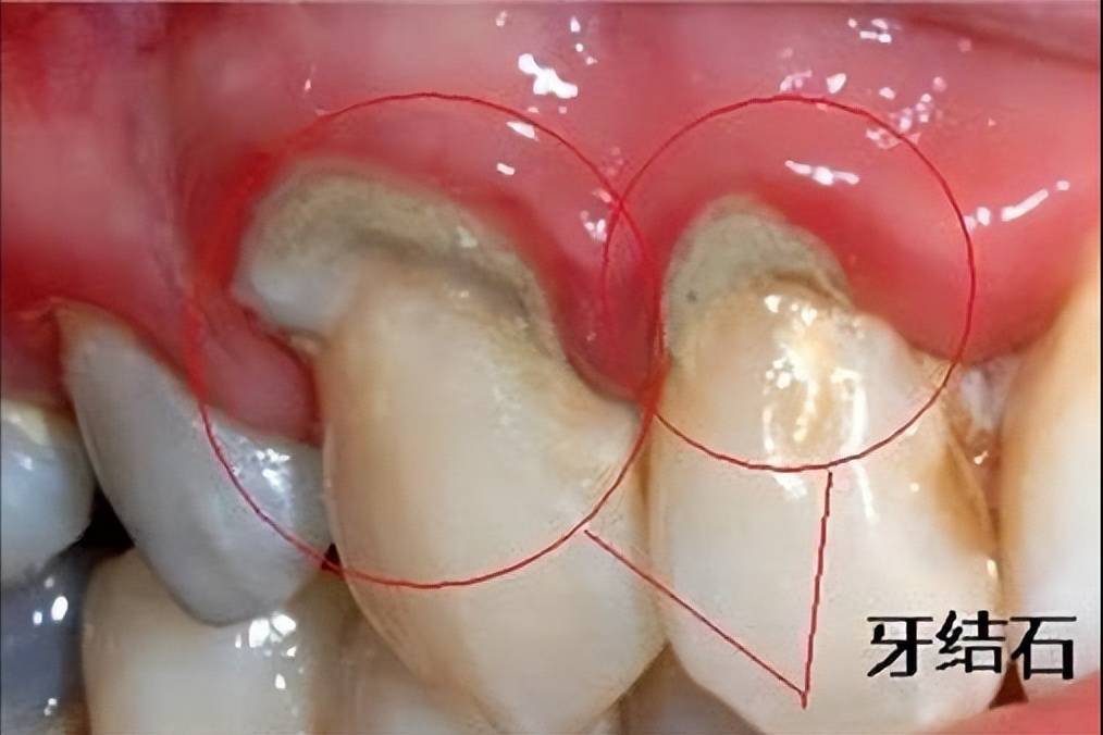 健康牙齿里面图片图片