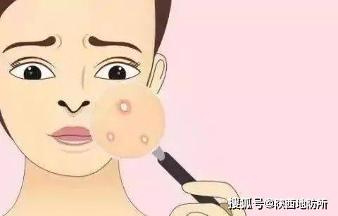 皮防科普 | 哪种痘痘容易留下痘印痘坑?