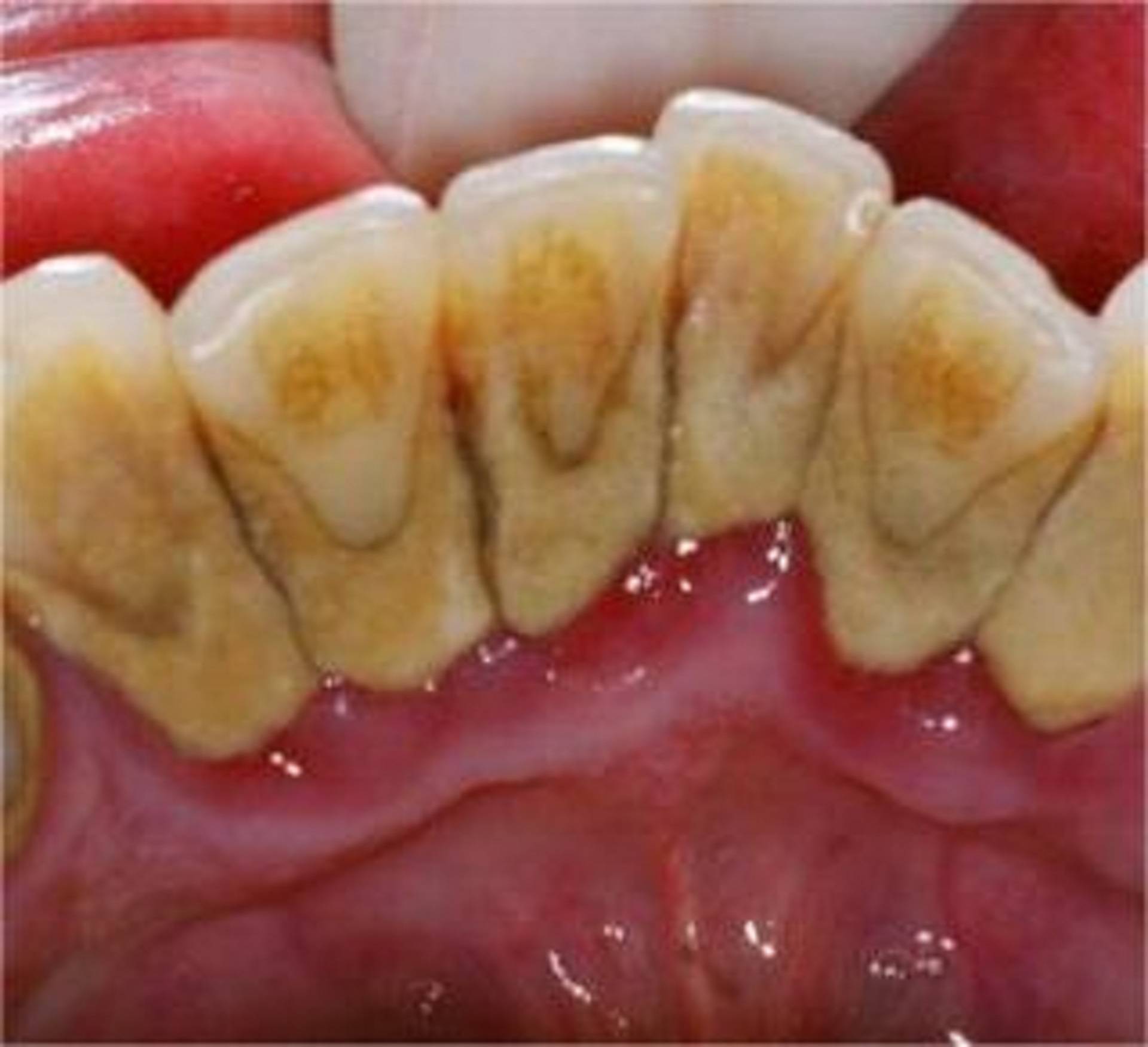 牙结石的本命牙粉!只用两个月全部脱落!