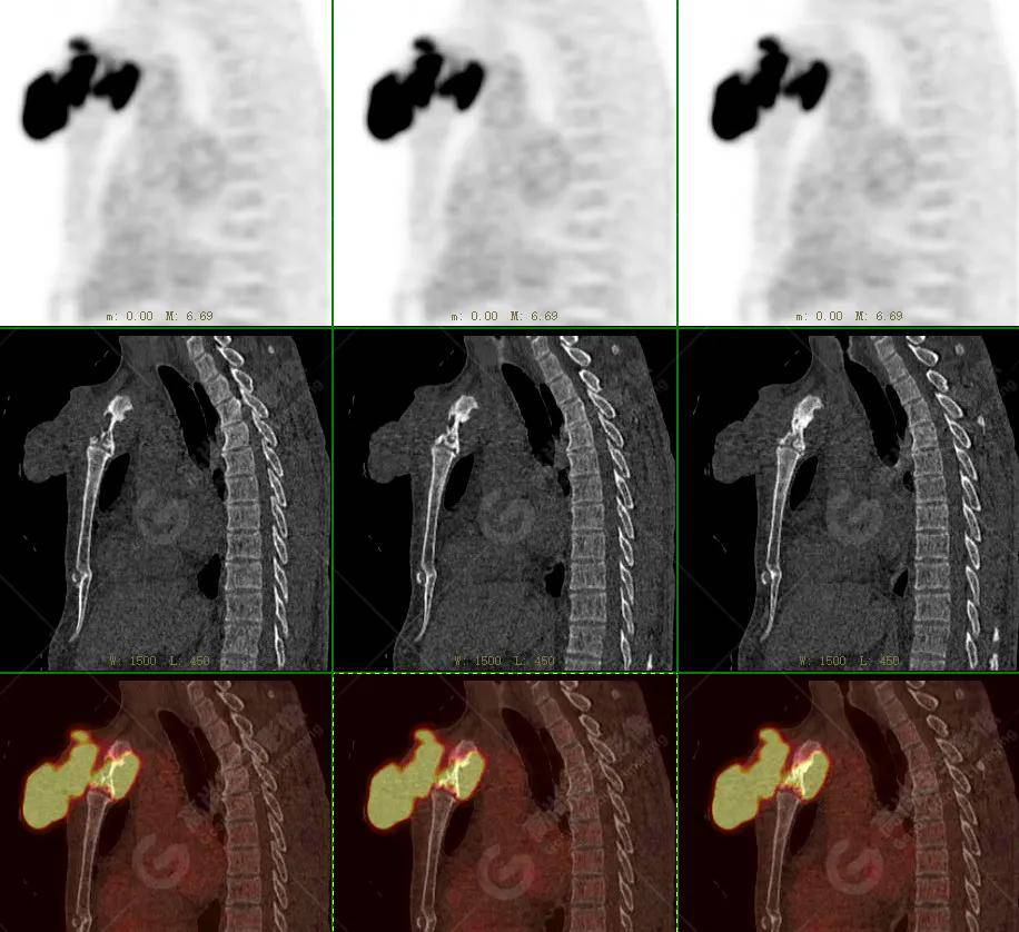【高尚病例】18f-fdg pet/ct显像应用于骨结核